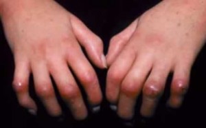 Image of Scleroderma