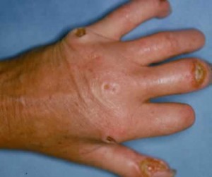 Picture of Scleroderma