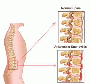 Image of Spondylitis