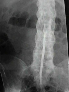 Picture of Spondylitis