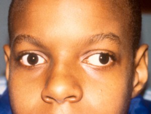 Picture of Strabismus