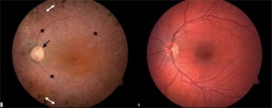 Image of Usher's Syndrome