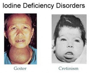 Picture of Iodine Deficiency