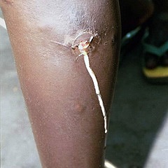 Image of Schistosomiasis
