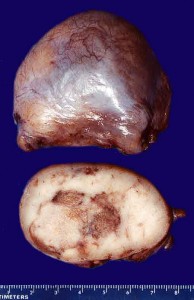 Image of Seminoma