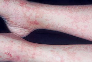 Picture of Serum sickness