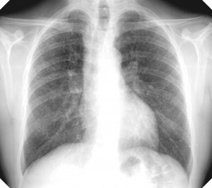 Image of Silicosis
