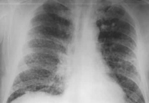 Picture of Silicosis