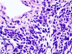 Picture of Small cell lung cancer 