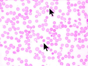 Image of Spherocytosis