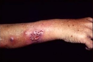 Image of Sporotrichosis