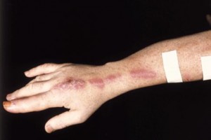 Picture of Sporotrichosis