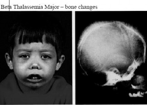 Image of Thalassemia