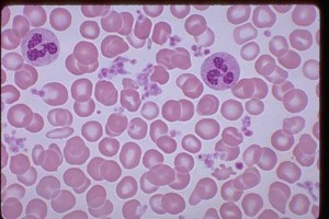 Image of Thrombocytosis