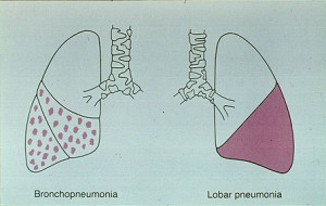 Picture of Bronchopneumonia