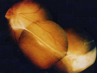 Image of Ocular Toxocariasis