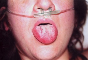 Image of Toxic Shock Syndrome