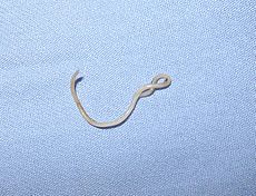 Picture of Toxocariasis (Canine roundworm)