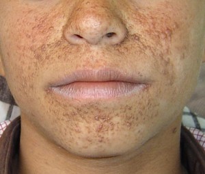 Picture of Tuberous sclerosis