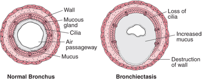 Image of Bronchiectasis