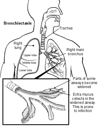Picture of Bronchiectasis