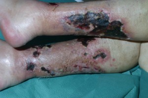 Image of Calciphylaxis