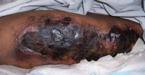 Picture of Calciphylaxis