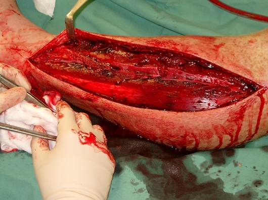 Picture of Compartment Syndrome