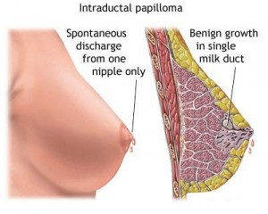 Image of Galactorrhea