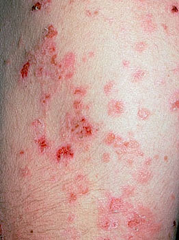 Picture of Pemphigus vulgaris