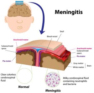 Cryptococcal meningitis