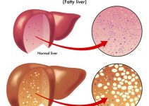 Fatty liver