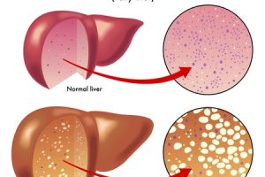 Fatty liver