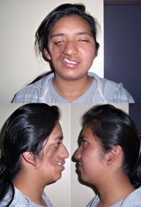 Parry Romberg Syndrome