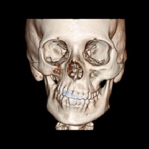 Parry Romberg syndrome CT reconstruction bone