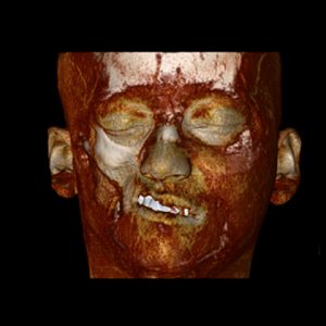 Parry Romberg syndrome CT reconstruction, soft tissues