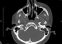 Parry Romberg Syndrome CT scan