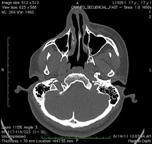 Parry Romberg Syndrome CT scan