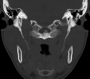 Ossifikationen im Ligamentum stylohyoideom beidseits - Eagle Syndrom CT