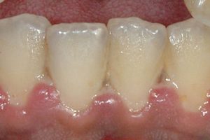 Trench Mouth - Ulcerative necrotizing gingivitis