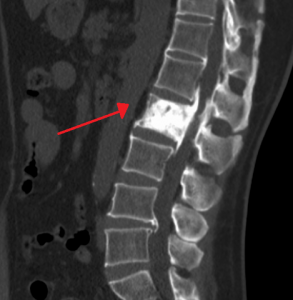 Paget’s Disease Ivory Vert L2