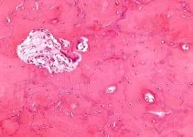 Paget disease of bone high mag