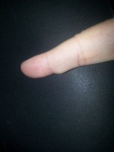 Synovial Cyst on the right index finger