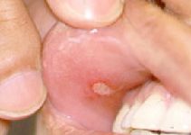 Behcet’s Disease