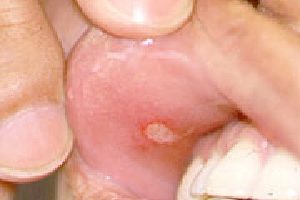 Behcet’s Disease