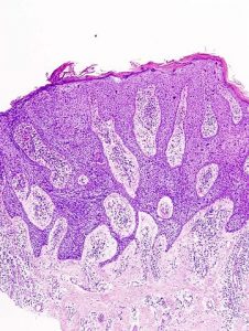 Histopathology of squamous cell carcinoma in situ of the skin (Bowen disease)