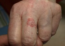 Bowen disease in 81-year-old-woman.