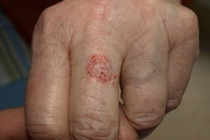 Bowen disease in 81-year-old-woman.