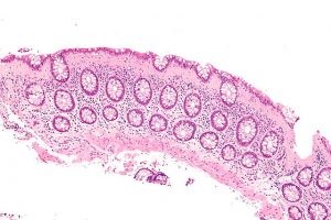 Collagenous colitis intermed mag (Inflamed colon)