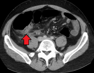 Appendicitis Mark